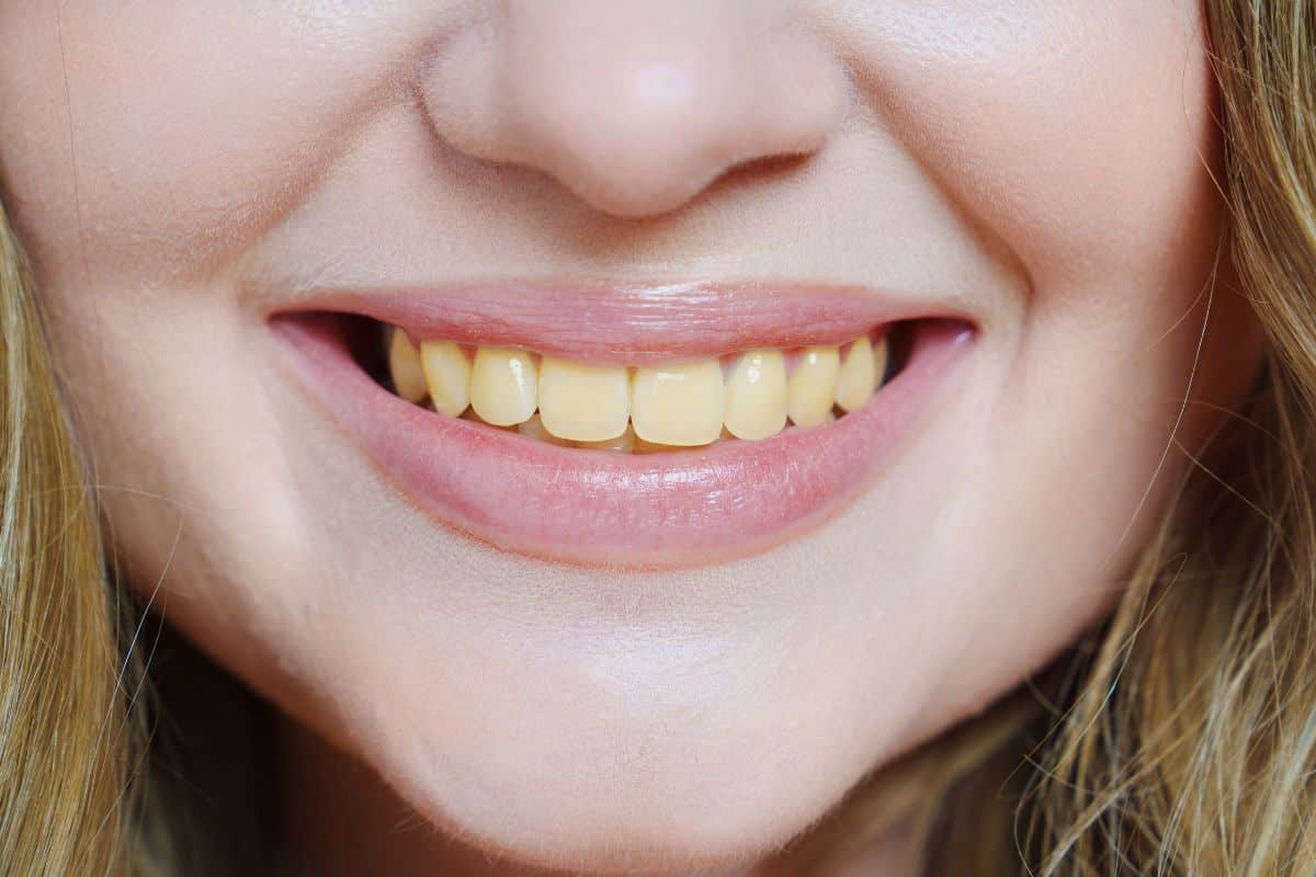 Yellow-Teeth-White-Again